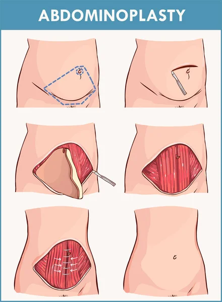 Addominoplastica Lipectomia Procedure — Vettoriale Stock