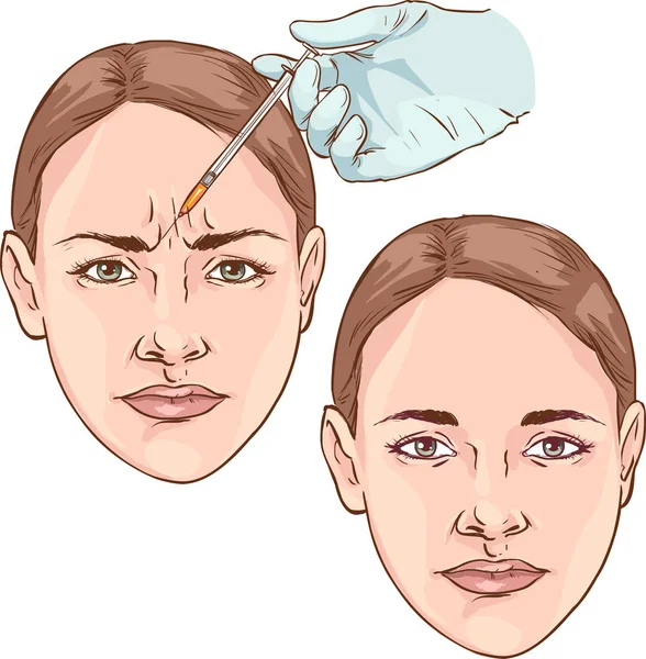 Wrinkles Forehead Rejuvenation Plastic Surgery — Stock Vector