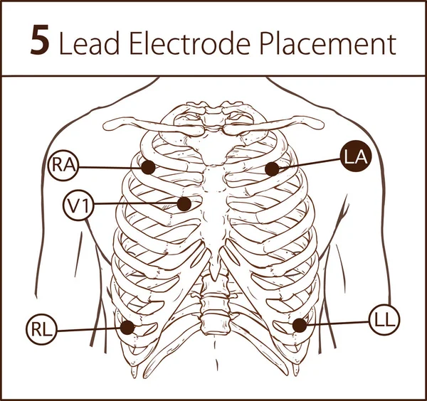 Ilustração Vetorial Colocação Eletrodo Derivações — Vetor de Stock