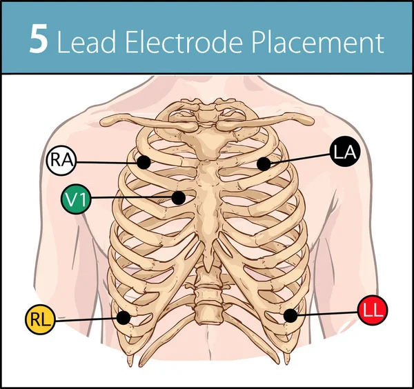 Illustration Vectorielle Placement Électrode Fils — Image vectorielle