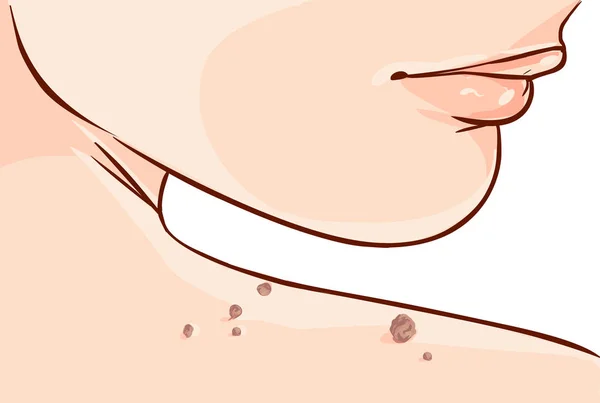 Vektorillustration Einer Methode Zur Entfernung Von Skin Tags — Stockvektor