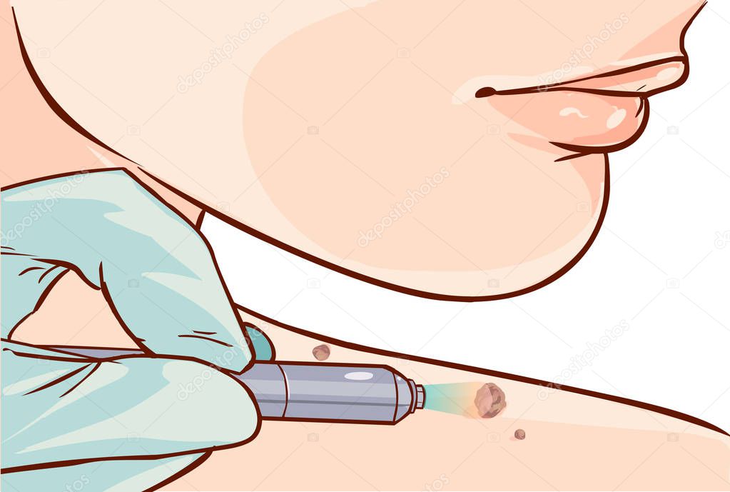Vector illustration of a Skin Tag Removal Methods