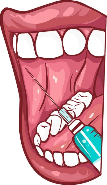 Oral Maxillofacial Regional Anesthesia — Stock Vector