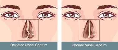 Nazal Septum sapma Treatmen