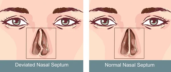 Носовое отклонение перегородки носа — стоковый вектор