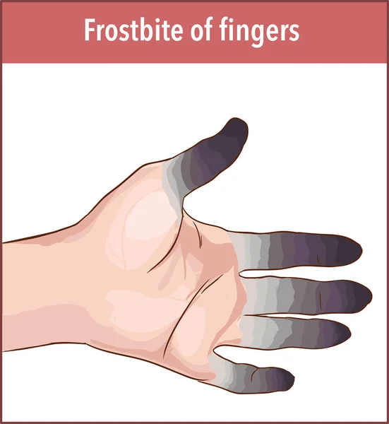 Vektorillustration Frostbite Finger — Stock vektor