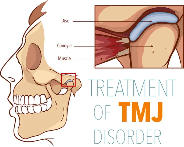 Vektorillustration Behandling Tmj Sjukdom — Stock vektor