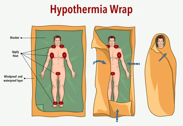 Ilustração Vetorial Envoltório Hipotermia Primeiros Socorros — Vetor de Stock