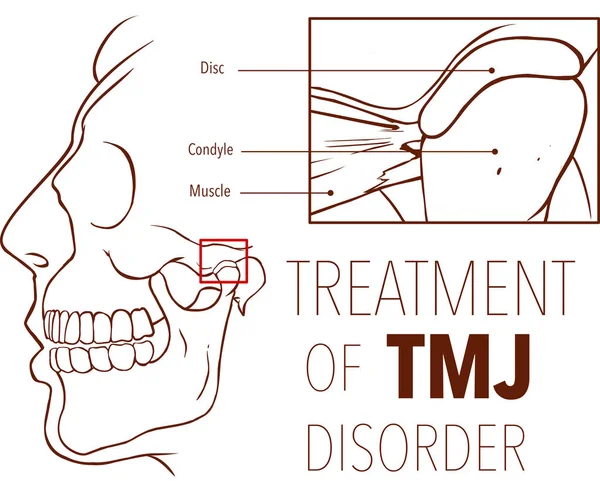 Vector Illustration Treatment Tmj Disorder — Stock Vector