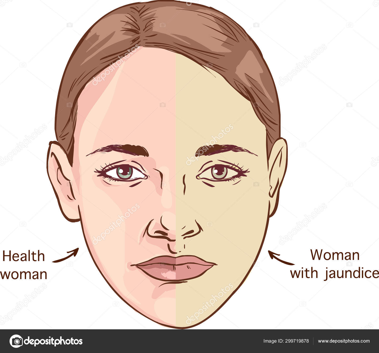 Comparison Normal Skin People Yellowing Jaundice Illustration Discolored  Stock Vector Image by © #299719878