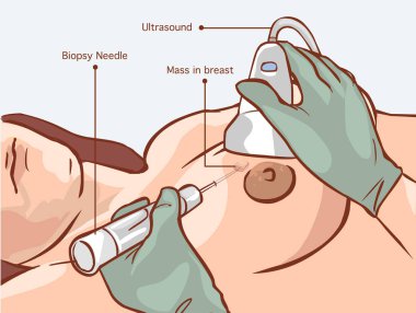 Meme Kanseri Teşhisi. Biyopsi. Tıp, patoloji, anatomi, 