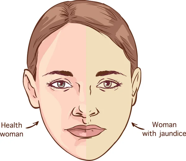Jämförelsen Mellan Normal Hud Människor Och Gulfärgning Från Gulsot Illustration — Stock vektor