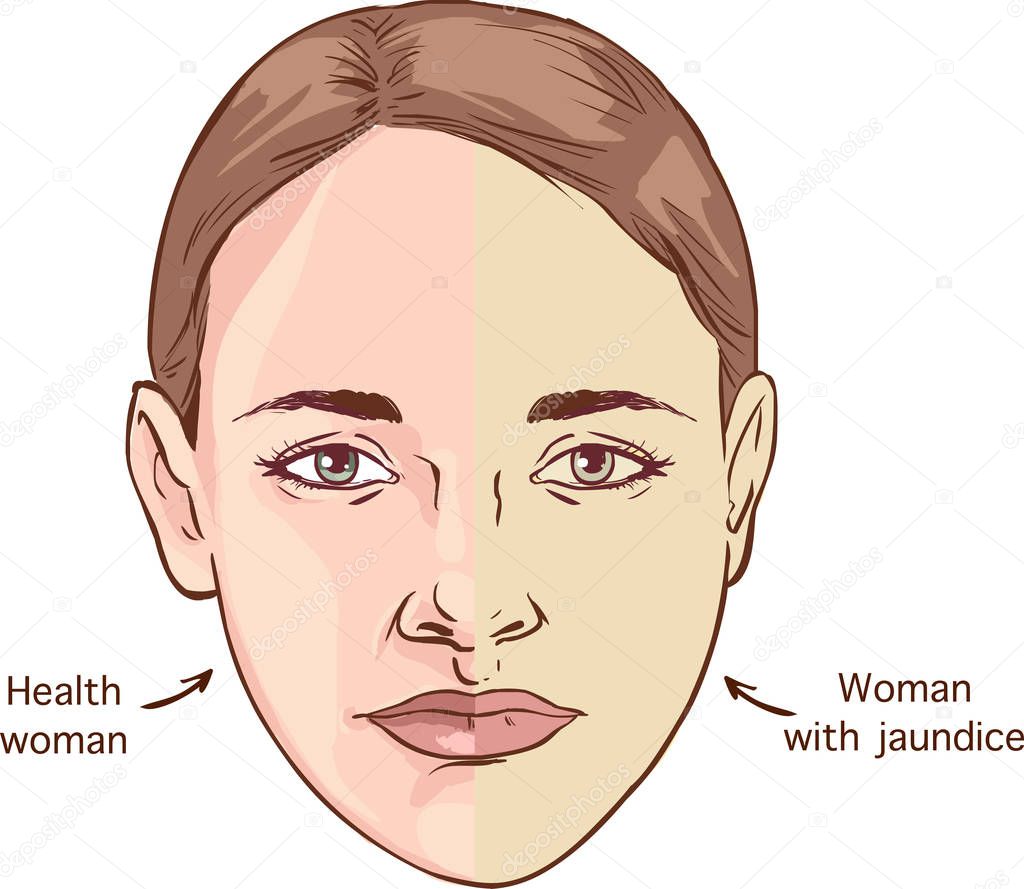 The Comparison between normal skin people and yellowing from Jaundice. Illustration, discolored.