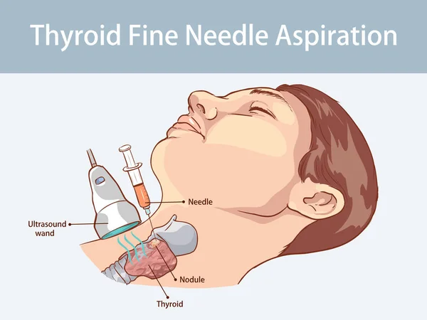 Aspiration Fine Des Nodules Thyroïdiens — Image vectorielle