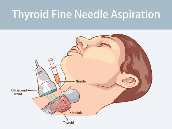 Tiroid Nodüllerinin İnce İğne Aspirasyonu