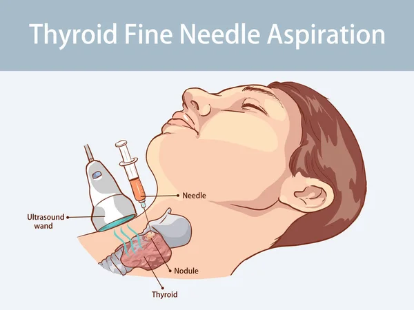 Tiroid Nodüllerinin Nce Ğne Aspirasyonu — Stok Vektör