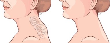 Kadın Belirti Buffalo Hump İllüstrasyon