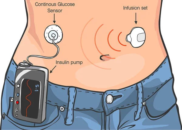 Векторная иллюстрация инсулиновых насосов — стоковый вектор