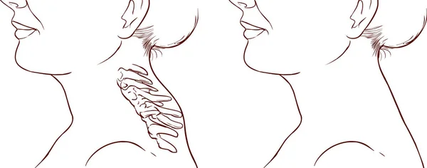 妇女 症状 水牛驼峰插图 — 图库矢量图片