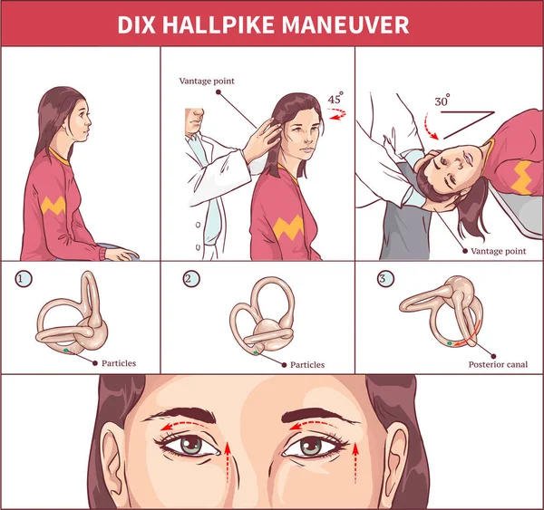 Dix Hallpike Maneuver Vector Illustration — 스톡 벡터