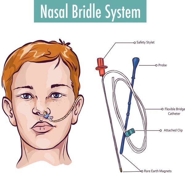 誤って抜け出すのを防ぐために鼻の敗血症に鼻管を取り付ける鼻の毛 — ストックベクタ