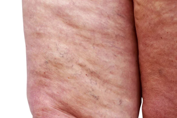 Disease Varicose Veins Legs — Stock Photo, Image