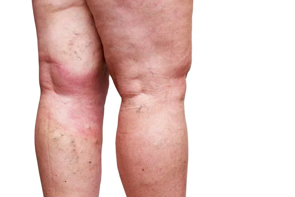 Die Krankheit Krampfadern Den Beinen — Stockfoto