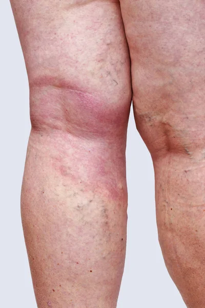 The varicose veins — Stock Photo, Image