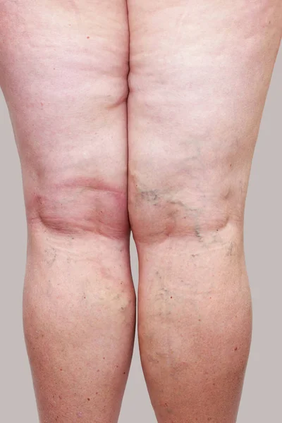 The varicose veins — Stock Photo, Image