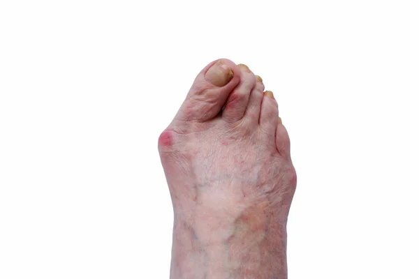 Curvature of the big toe — Stock Photo, Image