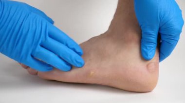 Bir doktor bir adamın ayağında nasırları muayene eder. Ayakta nasır tedavisi.
