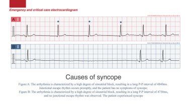 Bazı yavaş aritmi ataklarında, ritim bozukluğunun nedeni ritim bozukluğu değil, kaçış ve kaçış ritminin kaybıdır..