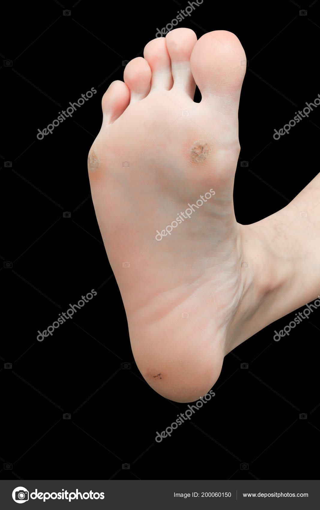 Black corn cheap foot