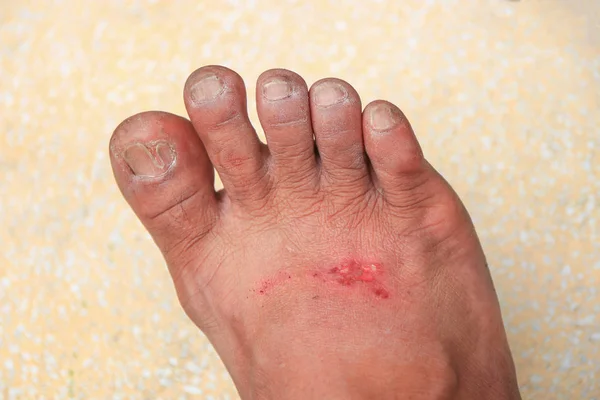Ayak Yara Alan Sığ Derinliği Ile Enfekte Seçin Odak Haline — Stok fotoğraf