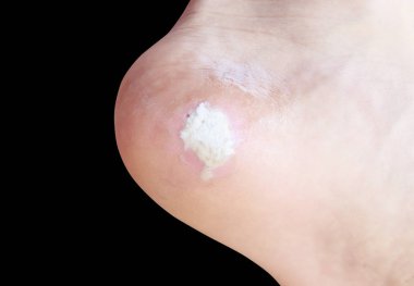 ağrı ayak Mısır siyah arka plan üzerine izole kapatmak 