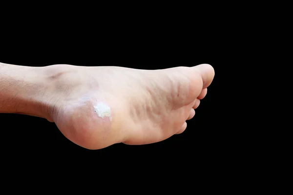 Close-up van pijn voet maïs geïsoleerd op zwarte achtergrond — Stockfoto