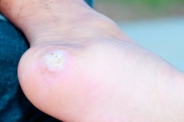 ağrı ayak Mısır kadar kapatın