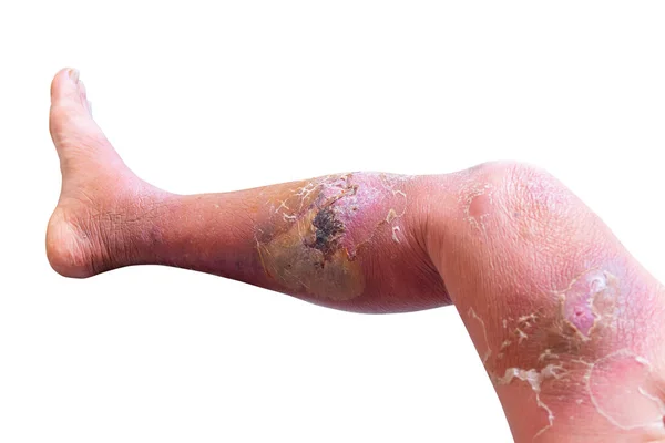 Erisipelas bakteriyel enfeksiyon deri bacak altında yaşlı insanlar — Stok fotoğraf