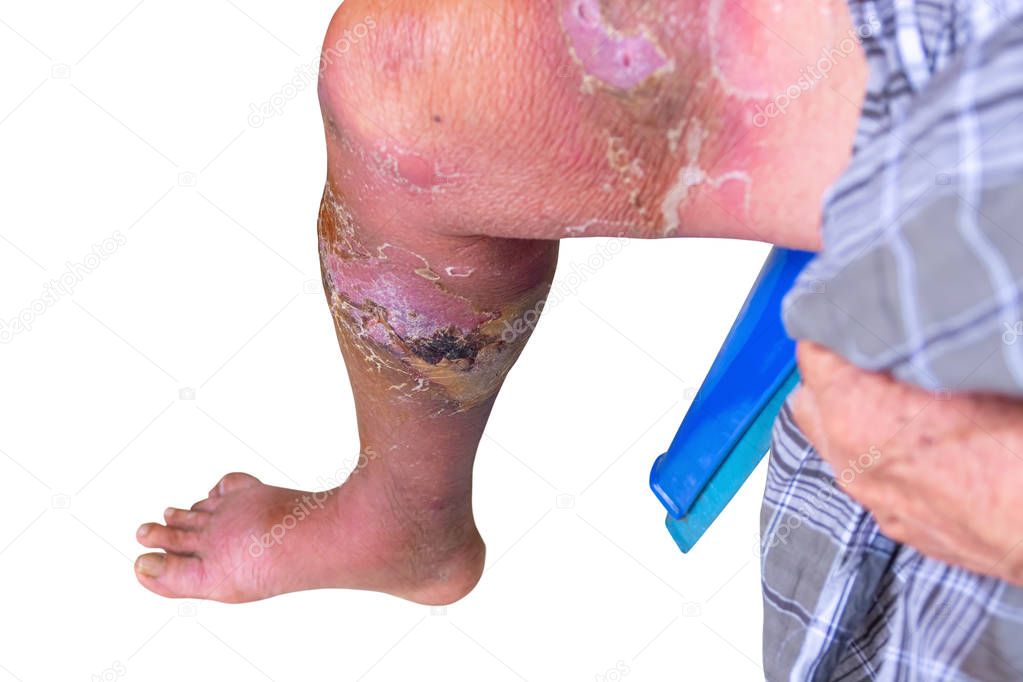 Erysipelas bacterial infection Under the skin leg aged people On  white background