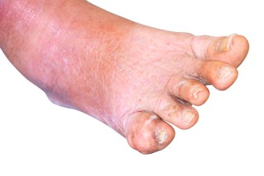 gout foot little finger in aged people Close up On white background clipart
