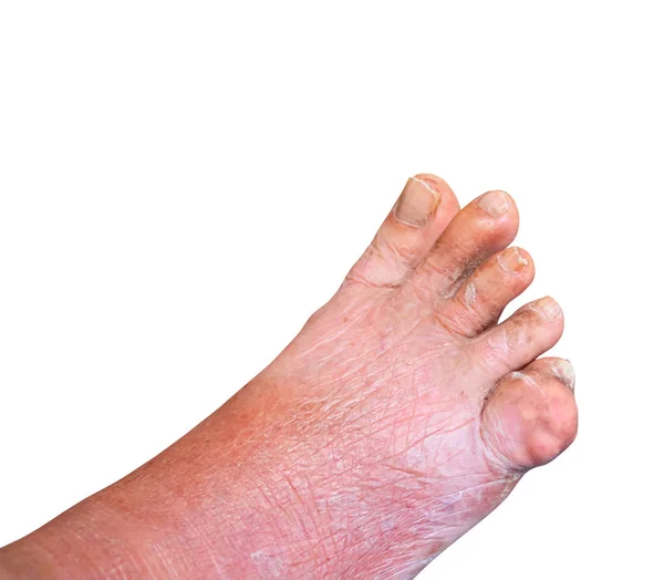 Gut ayak parmağı yaşlı insanlarda Beyaz arka planda yakın plan — Stok fotoğraf