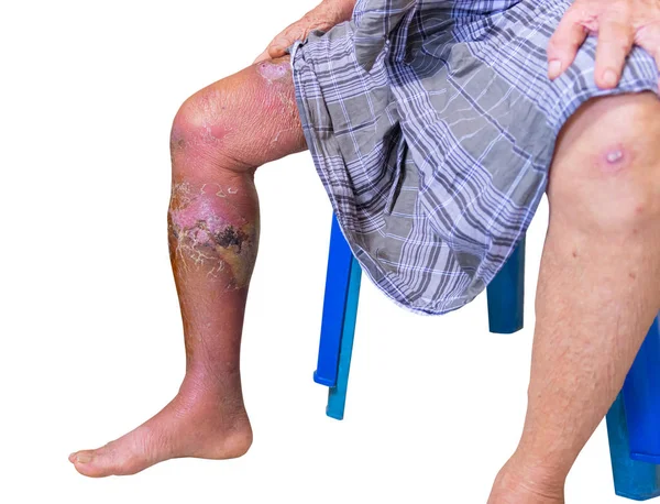 Erysipelas бактеріальна інфекція Під шкірою ноги літні люди На білому тлі — стокове фото