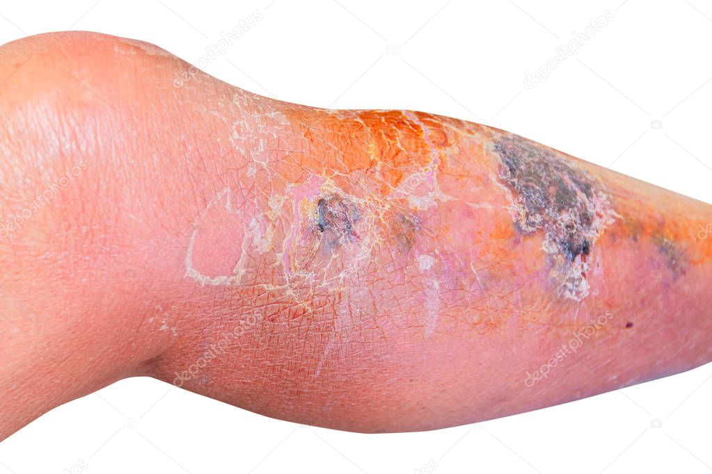 Erysipelas bacterial infection Under the skin leg aged people On white background