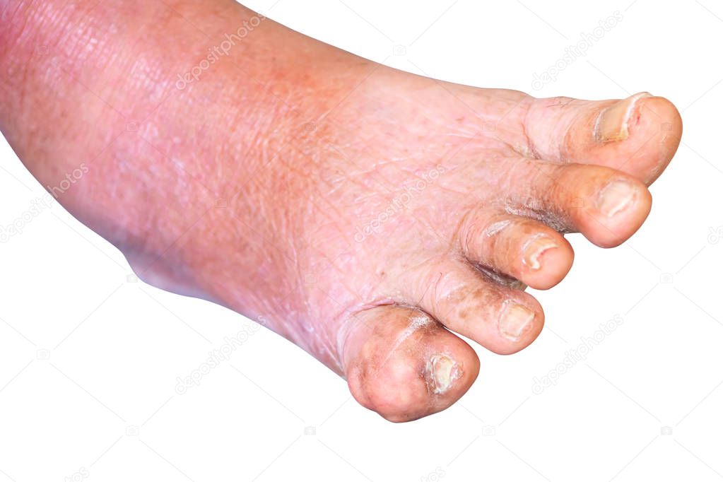 gout foot little finger in aged people Close up On white background