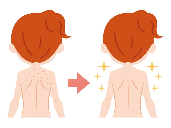 背部痤疮疤痕毛孔污垢妇女双后 — 图库矢量图片
