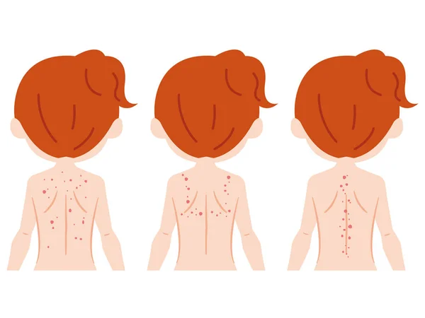 Mulher com eczema nas costas —  Vetores de Stock