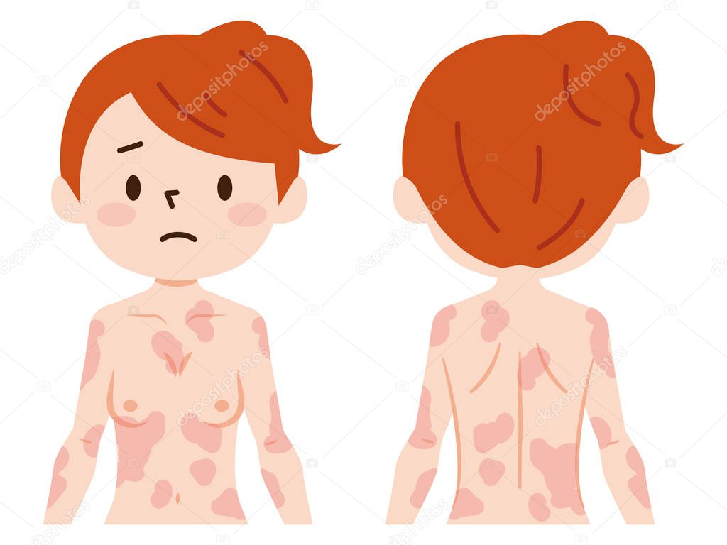 Skin disease on thebody.Vector illustration.