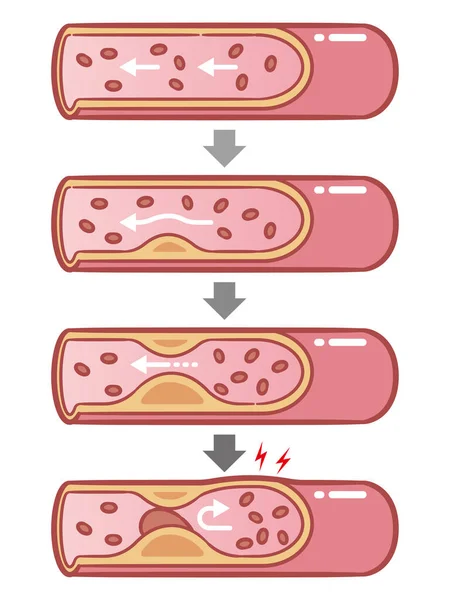 Vaisseaux Sains Athérosclérosés Avec Des Cellules Sanguines Illustration Vectorielle — Image vectorielle