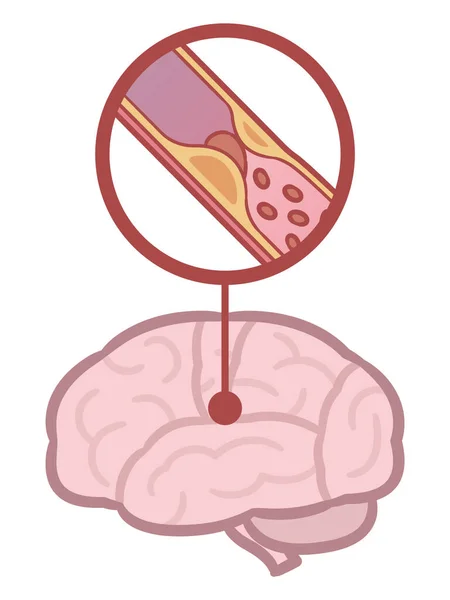 脑卒中 脑梗死图解 — 图库矢量图片