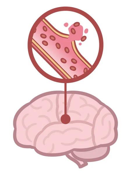 Ictus Cerebrale Illustrazione Dell Emorragia Cerebrale — Vettoriale Stock